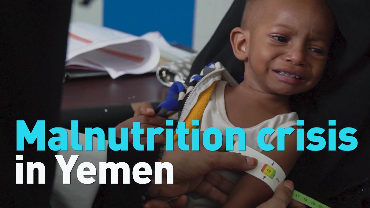 Malnutrition crisis in Yemen - CGTN