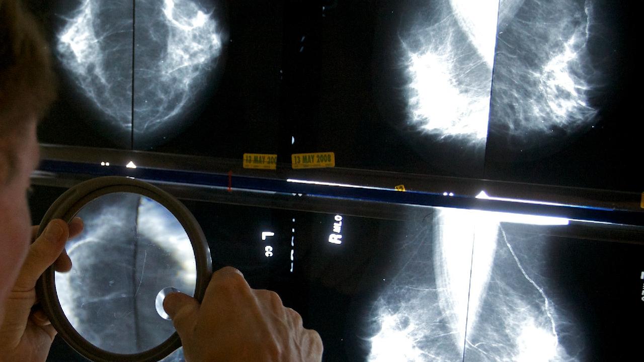 New Guidelines Drop Mammograms Screening Age From 50 To 40 - CGTN