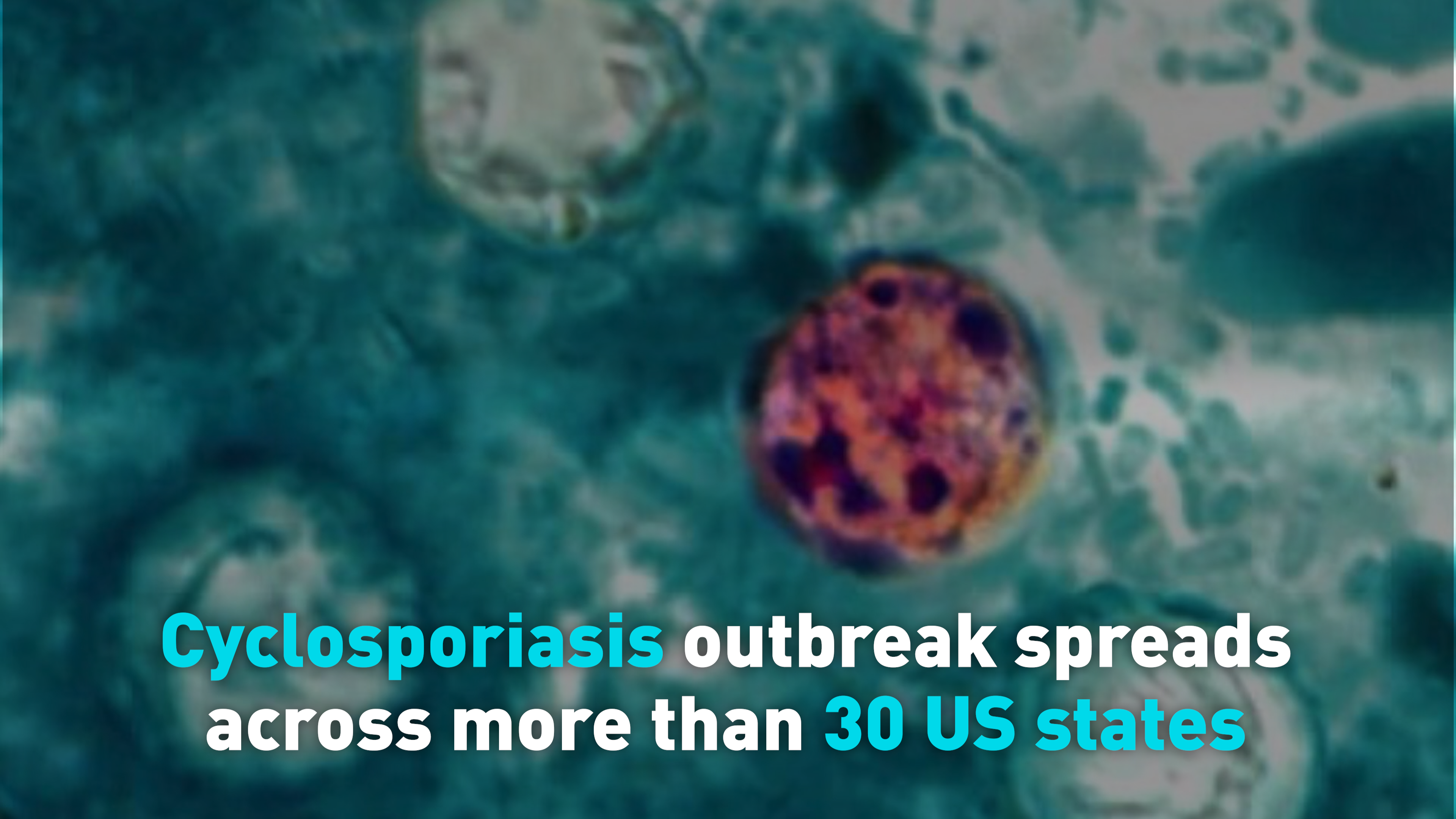 Cyclosporiasis outbreak spreads across more than 30 US states