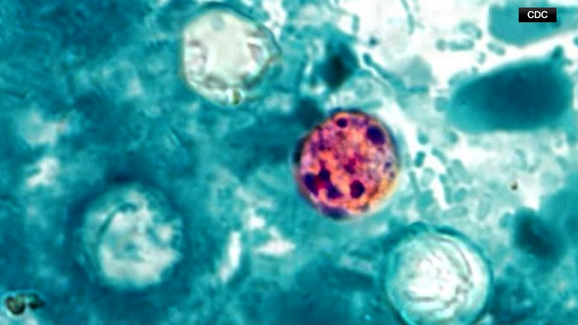 Parasite outbreak spreads nationwide